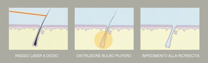 elimina permanentemente i peli dal tuo corpo grazie al laser a diodo